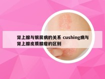 肾上腺与银屑病的关系 cushing病与肾上腺皮质腺瘤的区别