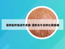 湿疹能转变成牛皮癣 湿疹会不会转化银屑病