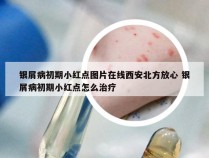 银屑病初期小红点图片在线西安北方放心 银屑病初期小红点怎么治疗