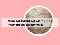 干细胞治银屑病研究效果咋样了 2020年干细胞治疗银屑病最新治疗公布