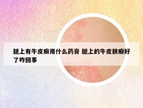 腿上有牛皮癣用什么药膏 腿上的牛皮肤癣好了咋回事