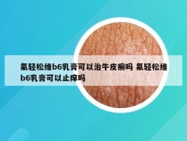 氟轻松维b6乳膏可以治牛皮癣吗 氟轻松维b6乳膏可以止痒吗