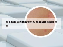 男人屁股旁边长癣怎么办 男生屁股周围长痘痘