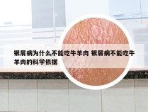 银屑病为什么不能吃牛羊肉 银屑病不能吃牛羊肉的科学依据