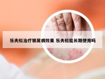 乐夫松治疗银屑病效果 乐夫松能长期使用吗