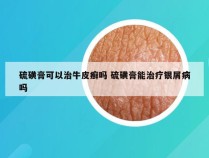 硫磺膏可以治牛皮癣吗 硫磺膏能治疗银屑病吗