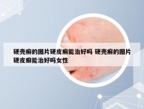 硬壳癣的图片硬皮癣能治好吗 硬壳癣的图片硬皮癣能治好吗女性