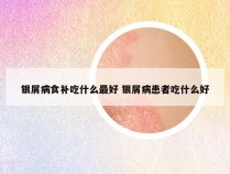 银屑病食补吃什么最好 银屑病患者吃什么好