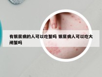 有银屑病的人可以吃蟹吗 银屑病人可以吃大闸蟹吗