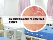 2023银屑病最新突破 银屑病2022年有望攻克