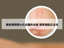 银屑病初期小红点图片头部 银屑病起红点点