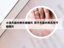 小孩大腿内侧长癣图片 孩子大腿内侧出现干癣图片