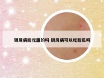 银屑病能吃甜的吗 银屑病可以吃甜瓜吗