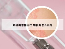 银消癣怎样治疗 银肖癣怎么治疗