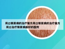 周口银屑病的治疗偏方周口银屑病的治疗偏方 周口治疗银屑病最好的医院