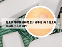 腿上长对称性的癣是怎么回事儿 两个腿上对称藓是什么造成的