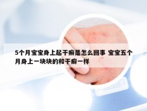 5个月宝宝身上起干癣是怎么回事 宝宝五个月身上一块块的和干癣一样