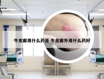 牛皮廨用什么药膏 牛皮廨外用什么药好