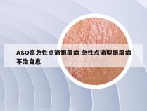 ASO高急性点滴银屑病 急性点滴型银屑病不治自愈