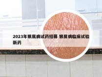 2023年银屑病试药招募 银屑病临床试验新药