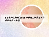 小朋友身上长癣怎么办 小孩身上长癣怎么办 癣的种类与辨别