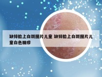 缺锌脸上白斑图片儿童 缺锌脸上白斑图片儿童白色糠疹