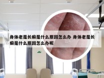 身体老是长癣是什么原因怎么办 身体老是长癣是什么原因怎么办呢