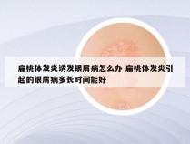 扁桃体发炎诱发银屑病怎么办 扁桃体发炎引起的银屑病多长时间能好