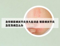 急性银屑病关节炎多久能消退 银屑病关节炎急性发病怎么办