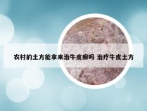 农村的土方能拿来治牛皮癣吗 治疗牛皮土方