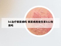 b1治疗银屑病吗 银屑病用维生素b12有用吗