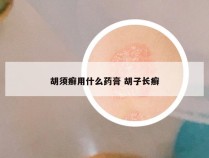 胡须癣用什么药膏 胡子长癣