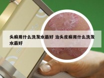 头癣用什么洗发水最好 治头皮癣用什么洗发水最好