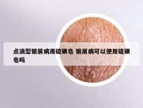 点滴型银屑病用硫磺皂 银屑病可以使用硫磺皂吗