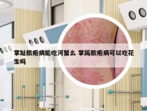 掌趾脓疱病能吃河蟹么 掌跖脓疱病可以吃花生吗