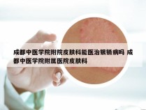 成都中医学院附院皮肤科能医治银销病吗 成都中医学院附属医院皮肤科