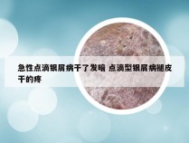 急性点滴银屑病干了发暗 点滴型银屑病褪皮干的疼