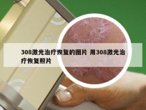 308激光治疗恢复的图片 用308激光治疗恢复照片