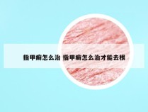 指甲癣怎么治 指甲癣怎么治才能去根