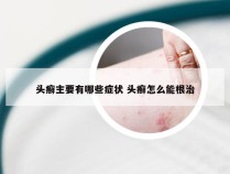 头癣主要有哪些症状 头癣怎么能根治