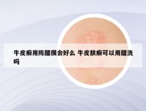 牛皮癣用陈醋摸会好么 牛皮肤癣可以用醋洗吗