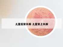 儿童后背长癣 儿童背上长癣