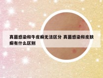 真菌感染和牛皮癣无法区分 真菌感染和皮肤癣有什么区别