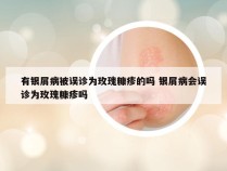 有银屑病被误诊为玫瑰糠疹的吗 银屑病会误诊为玫瑰糠疹吗