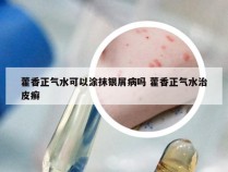 藿香正气水可以涂抹银屑病吗 藿香正气水治皮癣