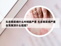 头皮银屑病什么时候最严重 头皮银屑病严重会发展到什么程度?