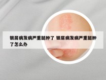 银屑病发病严重腿肿了 银屑病发病严重腿肿了怎么办