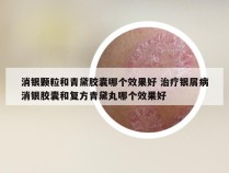 消银颗粒和青黛胶囊哪个效果好 治疗银屑病消银胶囊和复方青黛丸哪个效果好