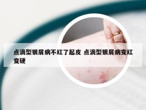 点滴型银屑病不红了起皮 点滴型银屑病变红变硬