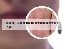 冬季吃什么影响银屑病 冬季银屑病复发用什么药